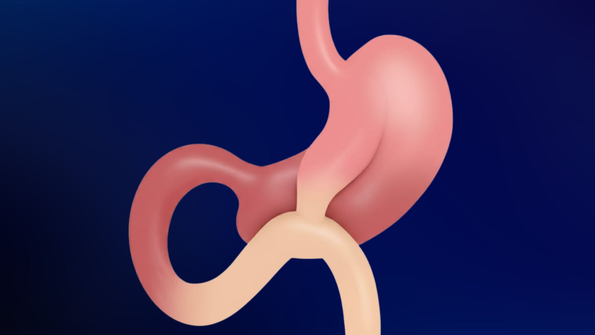 mini bypass gastrico en monterrey